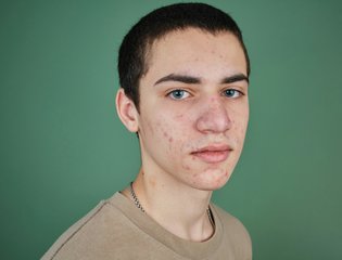 st-causes-spots-acne-body