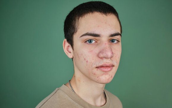 st-causes-spots-acne-body
