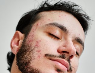 st-roaccutane-accutane-acne-body