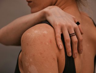 st-spots-on-back-body