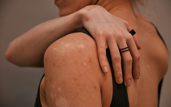 st-spots-on-back-body