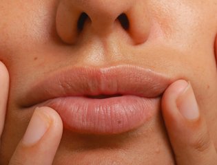 st-what-is-cold-sore-body