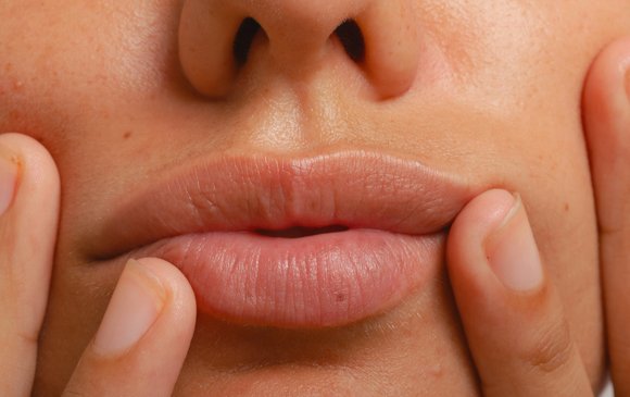 st-what-is-cold-sore-body